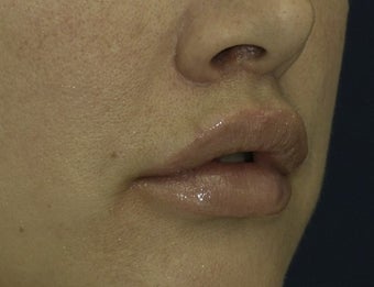 Lip Lift
