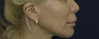 Lip Lift
