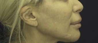 Lip Lift