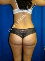 Liposuction