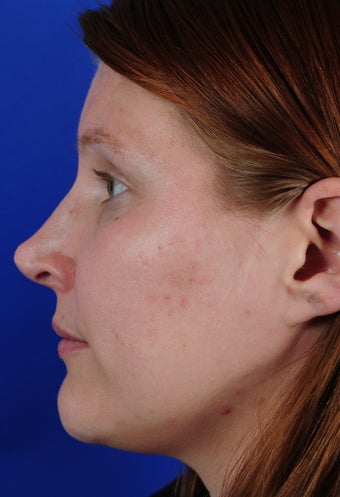 Revision Rhinoplasty