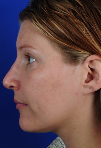Revision Rhinoplasty