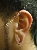 Earlobe Repair Surgery