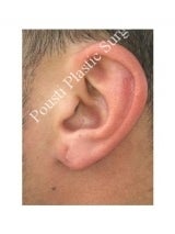 Earlobe Repair Surgery