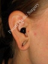 Earlobe Repair Surgery