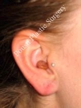 Earlobe Repair Surgery