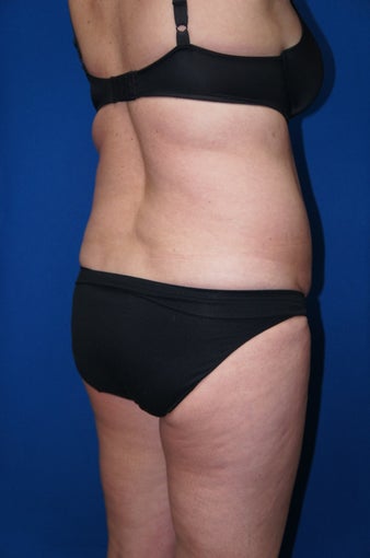 Liposuction