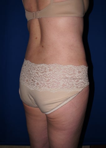 Liposuction