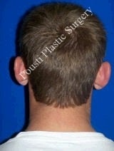 Ear Surgery (Otoplasty)
