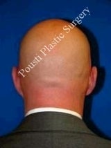 Ear Surgery (Otoplasty)