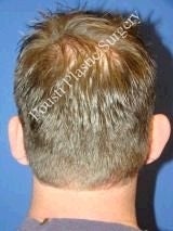 Ear Surgery (Otoplasty)