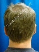 Ear Surgery (Otoplasty)