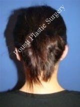 Ear Surgery (Otoplasty)