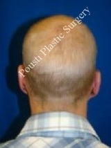 Ear Surgery (Otoplasty)