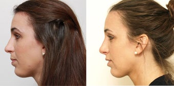 Septoplasty with rhinoplasty