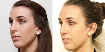 Septoplasty with rhinoplasty
