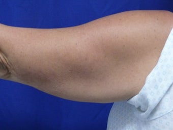 54 Year Old Female Brachioplasty 