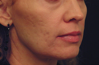 Yag Laser Skin Tightening 