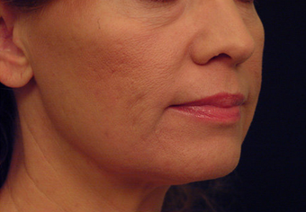 Yag Laser Skin Tightening 