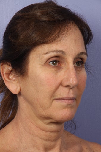 53 yr old Face and Necklift