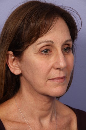 53 yr old Face and Necklift