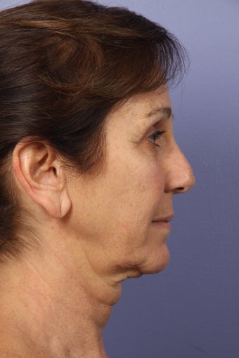 53 yr old Face and Necklift