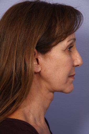 53 yr old Face and Necklift
