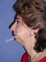Chin Implants
