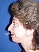 Chin Implants