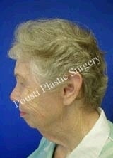 Chin Implants, Dermabrasion, Face Lift, Forehead Lift, Neck Lift