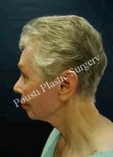 Chin Implants, Dermabrasion, Face Lift, Forehead Lift, Neck Lift