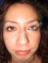 Chin Implants, Nose Surgery (Rhinoplasty)