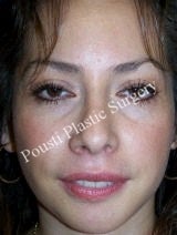 Chin Implants, Nose Surgery (Rhinoplasty)