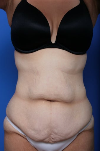 Body Lift