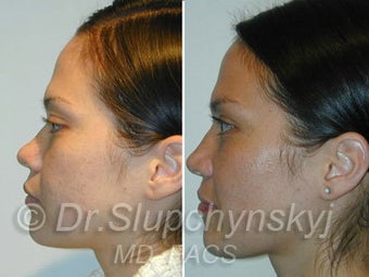 Asian Rhinoplasty