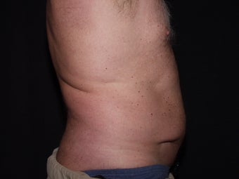 Smart Lipo Abs and Flanks