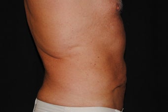 Smart Lipo Abs and Flanks