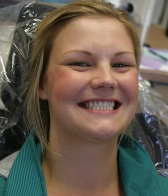 Upper arch make over with veneers and crowns