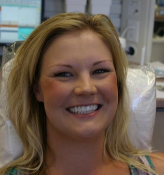 Upper arch make over with veneers and crowns