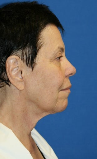 Facelift with Extended Necklift, Browlift, Fat Transfer, Upper Blepharoplasty, and Skin Pinch