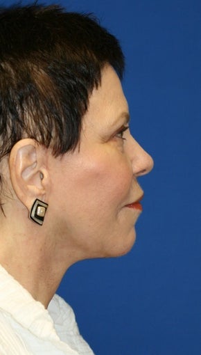 Facelift with Extended Necklift, Browlift, Fat Transfer, Upper Blepharoplasty, and Skin Pinch