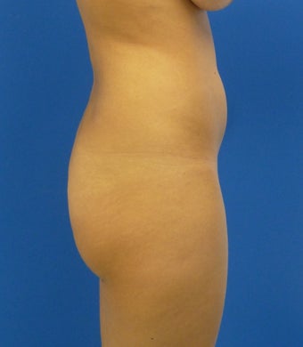 Buttock Augmentation