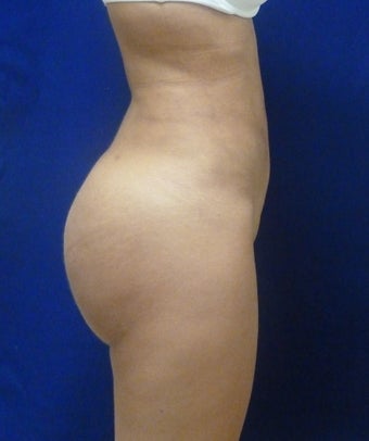 Buttock Augmentation