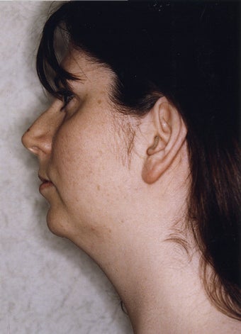 Neck Liposuction