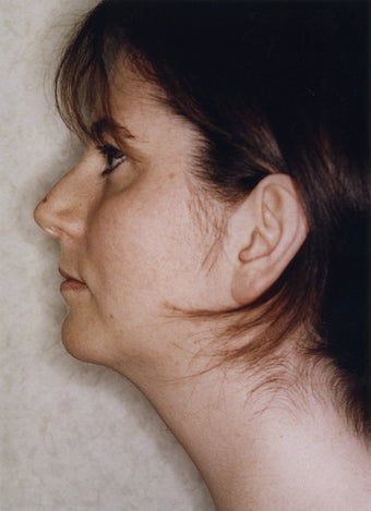 Neck Liposuction