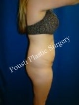 Liposuction, Tummy Tuck (Abdominoplasty)