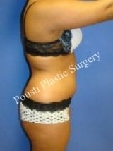 Liposuction