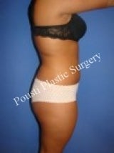 Liposuction