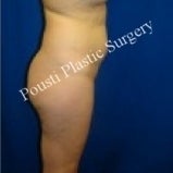 Liposuction