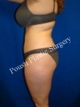 Liposuction